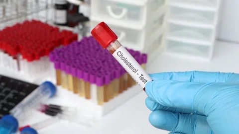 Cholesterol test to look for abnormalities from blood Stock Footage 221421041