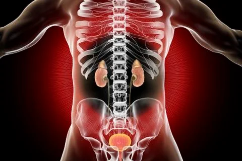 Chronic glomerulonephritis, gross pathology Stock Illustration