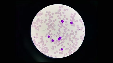 Chronic lymphoblastic leukeamia cell stop motion. Stock Footage 230861771
