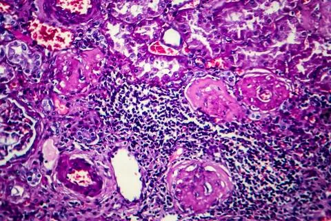 Chronic nephritis, light micrograph Stock Photos