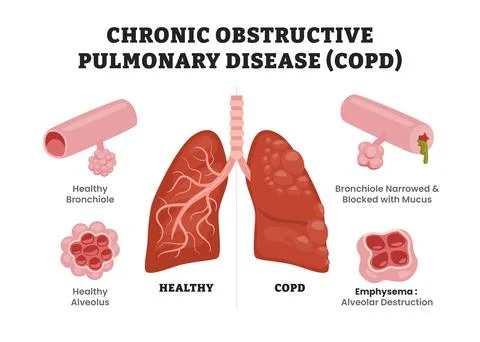 Chronic Obstructive Pulmonary Disease (COPD) vs Healthy Lungs, educational .. Stock Illustration