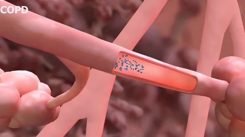 Chronic obstructive pulmonary disease Stock Footage 264660209