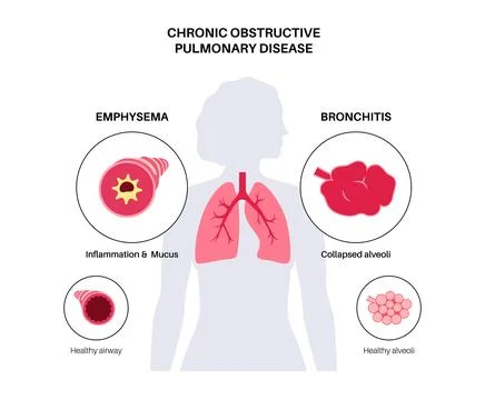 Chronic obstructive pulmonary disease Stock Illustration