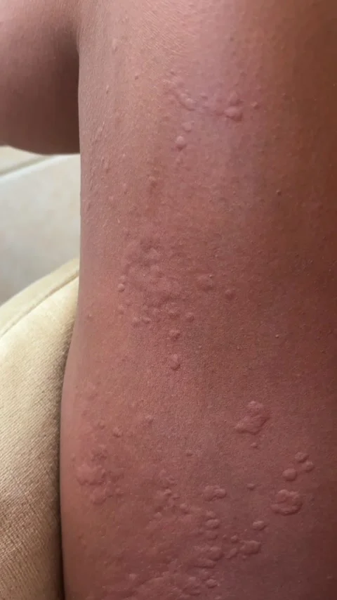 Chronic spontaneous urticaria rash Vídeos de archivo 342472483