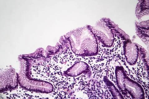 Chronic superficial gastritis, light micrograph Illustrazione stock