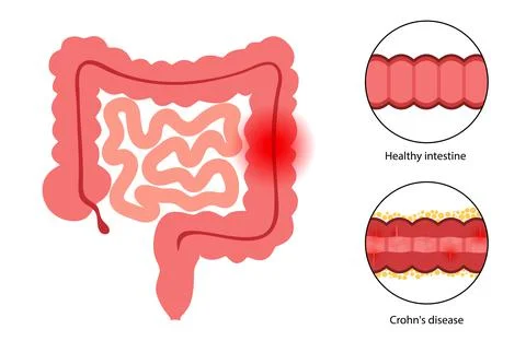 Chrons disease concept Stock Illustration