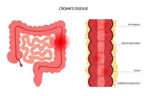 Chrons disease concept Stock Illustration