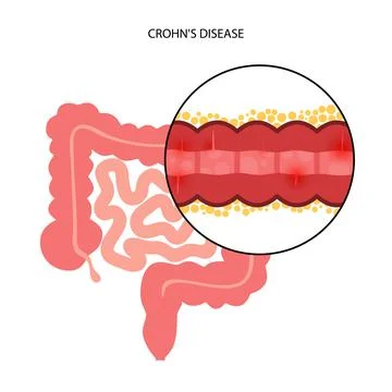 Chrons disease concept Stock Illustration