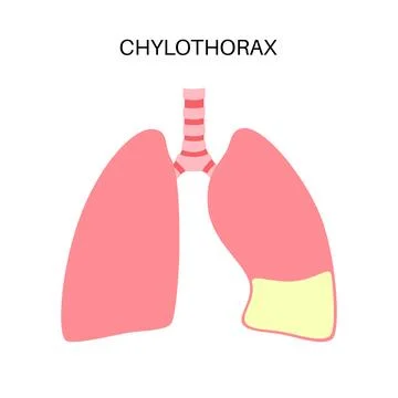 Chylothorax anatomical poster Ilustración de archivo