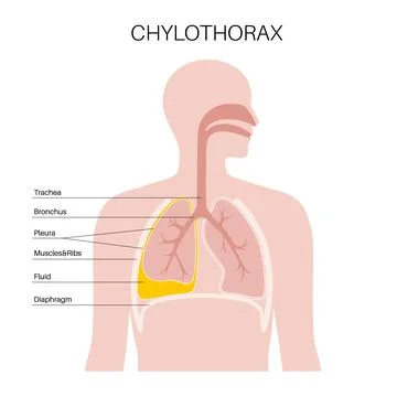 Chylothorax anatomical poster イラスト素材