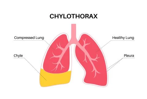 Chylothorax anatomical poster Stock Illustration
