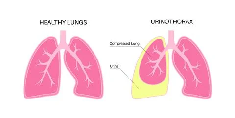 Chylothorax anatomical poster 库存插图