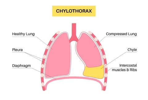 Chylothorax anatomical poster Stock Illustration