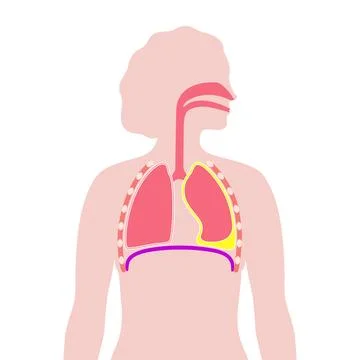 Chylothorax anatomical poster Stock Illustration