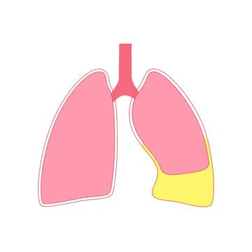Chylothorax anatomical poster Stock Illustration