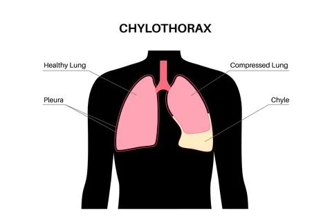 Chylothorax anatomical poster Stock Illustration