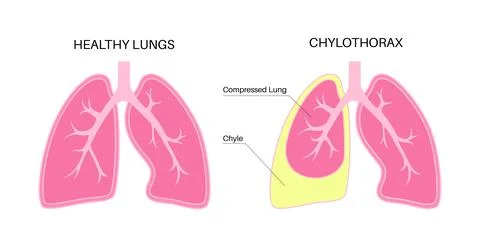 Chylothorax anatomical poster Stock Illustration