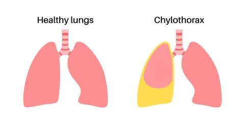 Chylothorax anatomical poster Stock Illustration