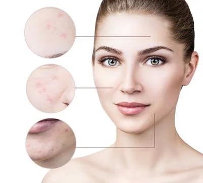 Circles shows problem skin of young woman. Stock Photos