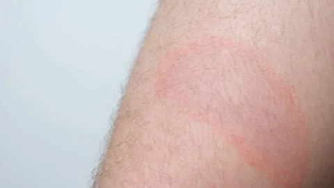 Circular red skin lesion characteristic of Borreliosis infection Stock Footage 340385847