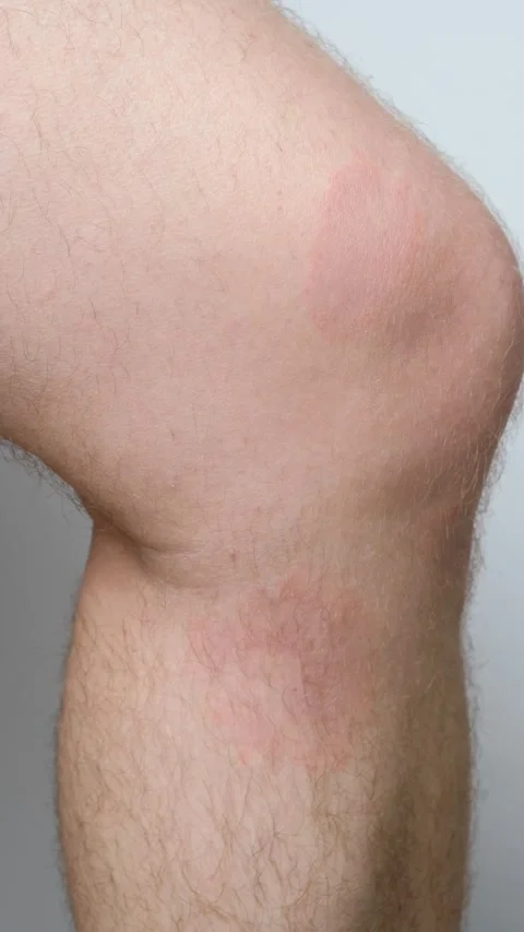 Circular red skin lesion characteristic of Borreliosis infection Stock Footage 340385876