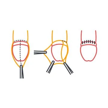Circumcision line icon, vector illustration Stock Illustration