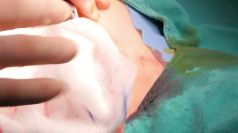 Circumcision surgery operation of a boy in hospital surgeon room Stock Footage 59081982