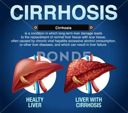 Cirrhosis of the Liver Infographic ~ Clip Art #238055455