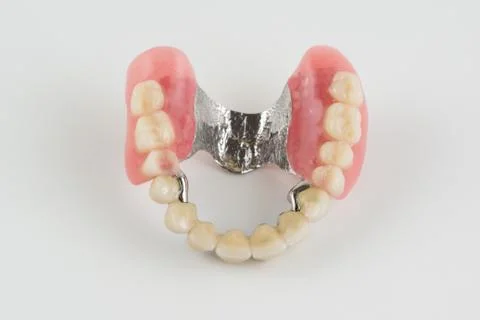 Clasp prosthesis with and latch ceramic crowns Stock Photos