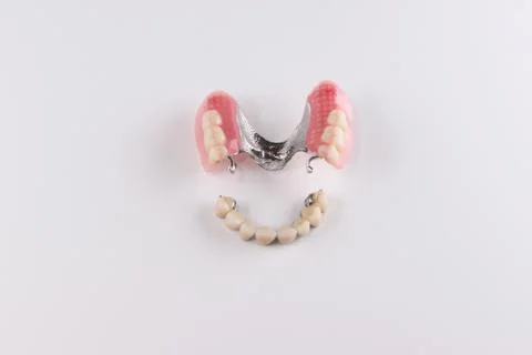 Clasp prosthesis with attachments fixing ceramic crowns Stock Photos
