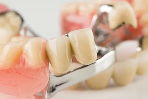 Clasp prosthesis with lock fixation Stock Photos