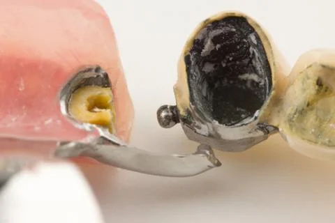 Clasp prosthesis with lock fixation Stock Photos