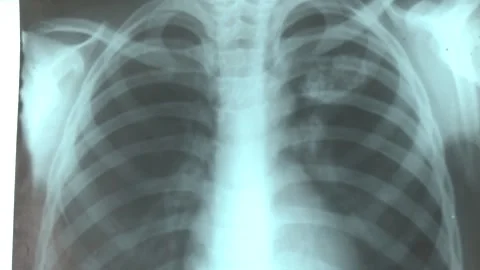 Classical projection chest radiographic examination. Stock Footage 282197772