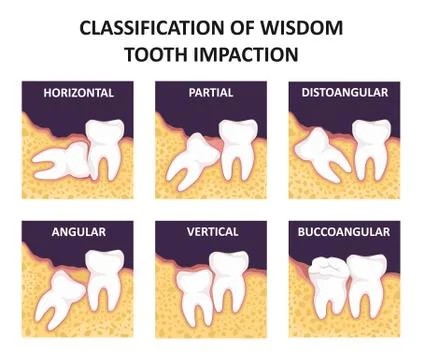 Classification of wisdom tooth impaction Stock Illustration