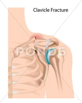 Clavicle fracture Stock Illustration