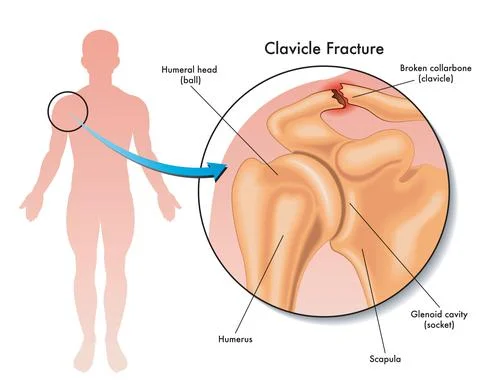 Clavicle fracture Stock Illustration