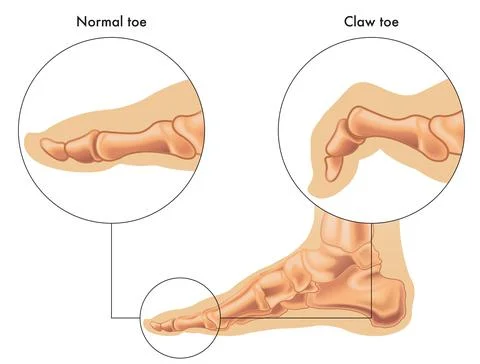 Claw toe Stock Illustration