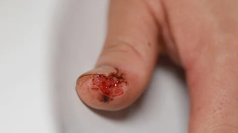 Clean the wound11 Video stock 126746511