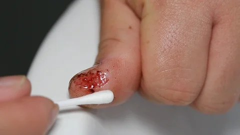 Clean the wound14 Video stock 126746542