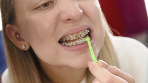 Cleaning braces teeth system, close-up. Stock Footage 167201854