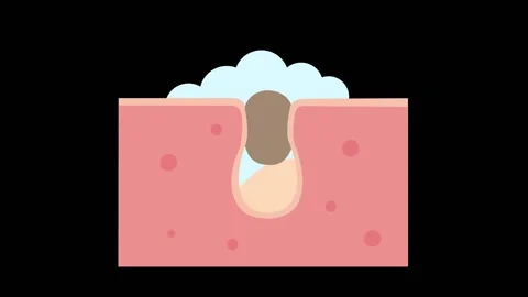 Cleaning clogged pores process 2D animation Stock Footage 153572052