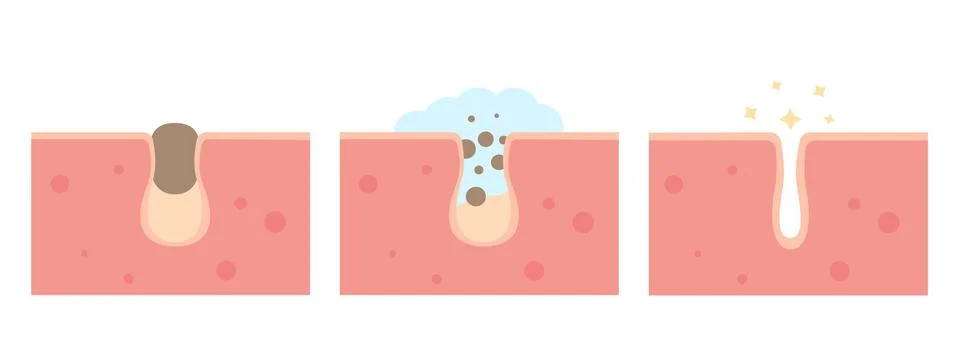 Cleaning clogged pores process Illustrazione stock