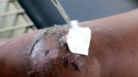 Cleaning infected wound on knee Stock-Footage 90755745