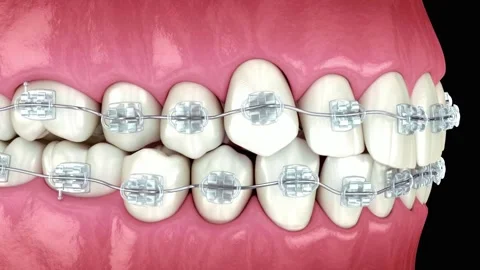 Clear Braces Correcting Crooked Teeth in Animation Stock Footage 327670007