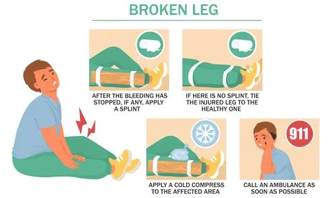 Clear instructions are provided for treating a broken leg, including applying a Stock Illustration