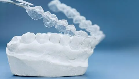 Clear Orthodontic Aligner Over Plaster Teeth Model 스톡 사진