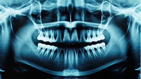 A clear panoramic dental X-ray showing human teeth Stock Footage 340318339