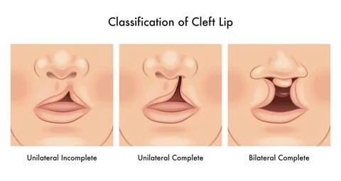 Cleft lip Stock Illustration