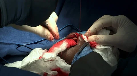 Cleft Lip Surgery Stock Footage 32134367