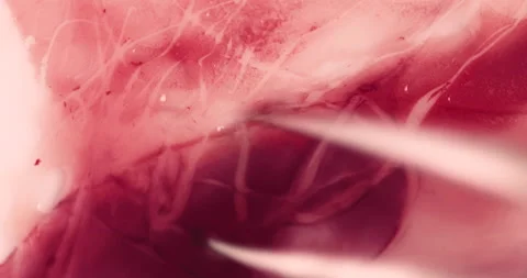 Clinical depression Stock Footage 241092944